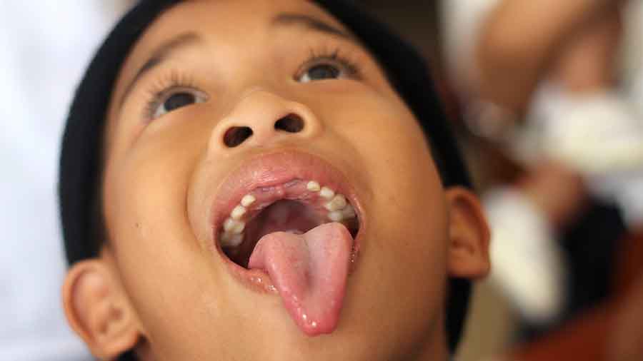 Ini Cara Mengatasi Cadel pada Anak