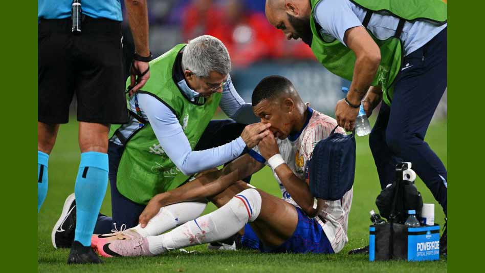 Tulang Hidungnya Patah, Mbappe Terancam di Piala Eropa 2024
