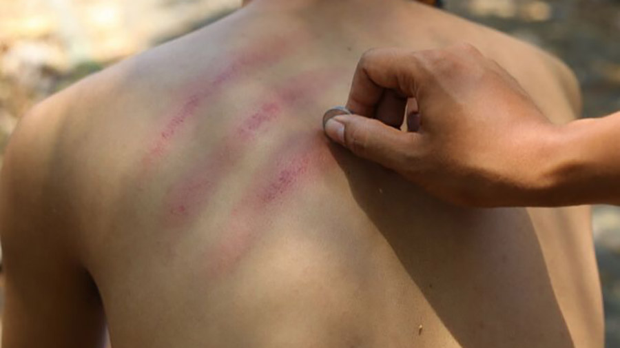 kenapa-kerokan-bisa-atasi-masuk-angin-begini-penjelasan-ilmiahnya