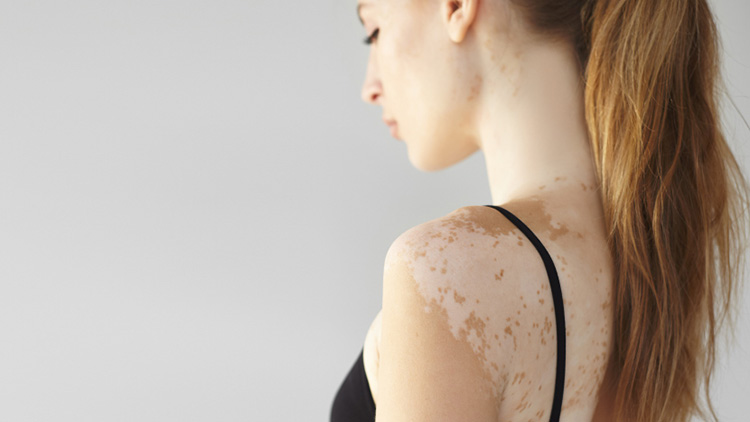 catat-begini-kunci-mencegah-panu-kembali