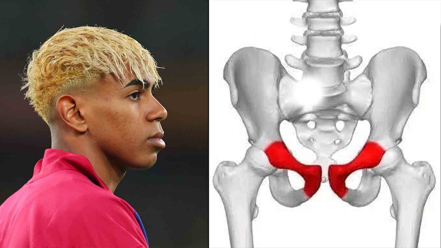 Cedera Lamine Yamal Pernah Terjadi Pada Messi,  Ternyata Mengerikan!