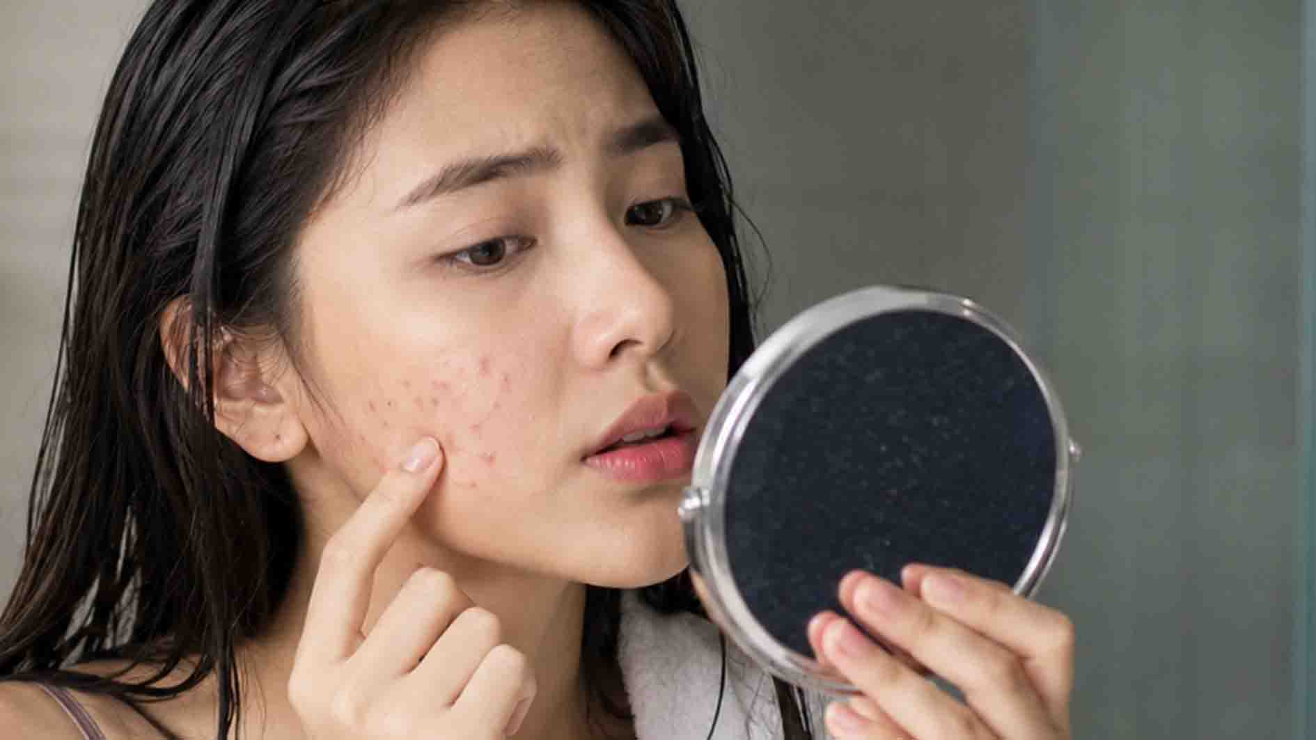 Ini Ciri-Ciri Kelebihan Protein pada Kulit dan Cara Mengatasinya
